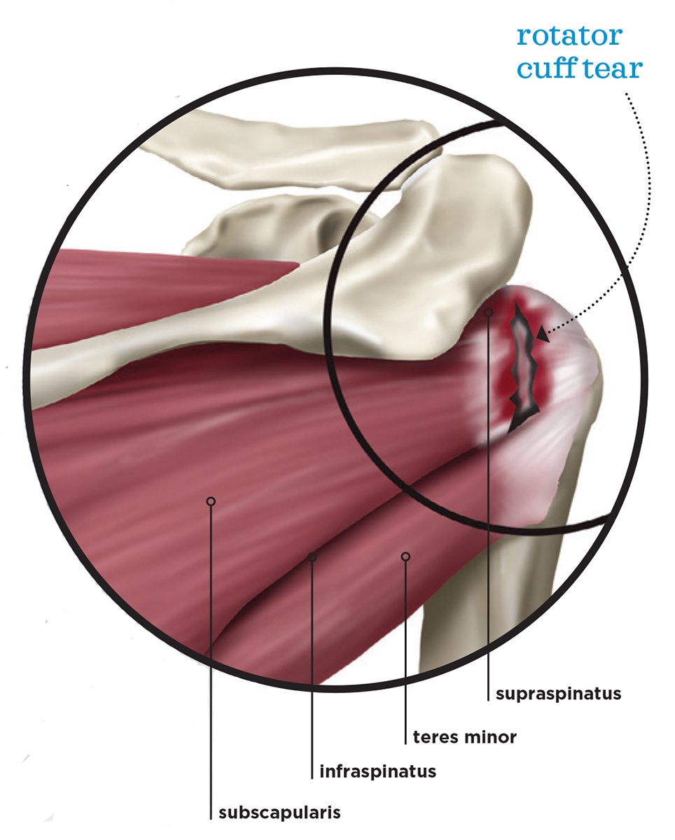 Anatomy 101 The Rotator Cuff The Hand Society - vrogue.co