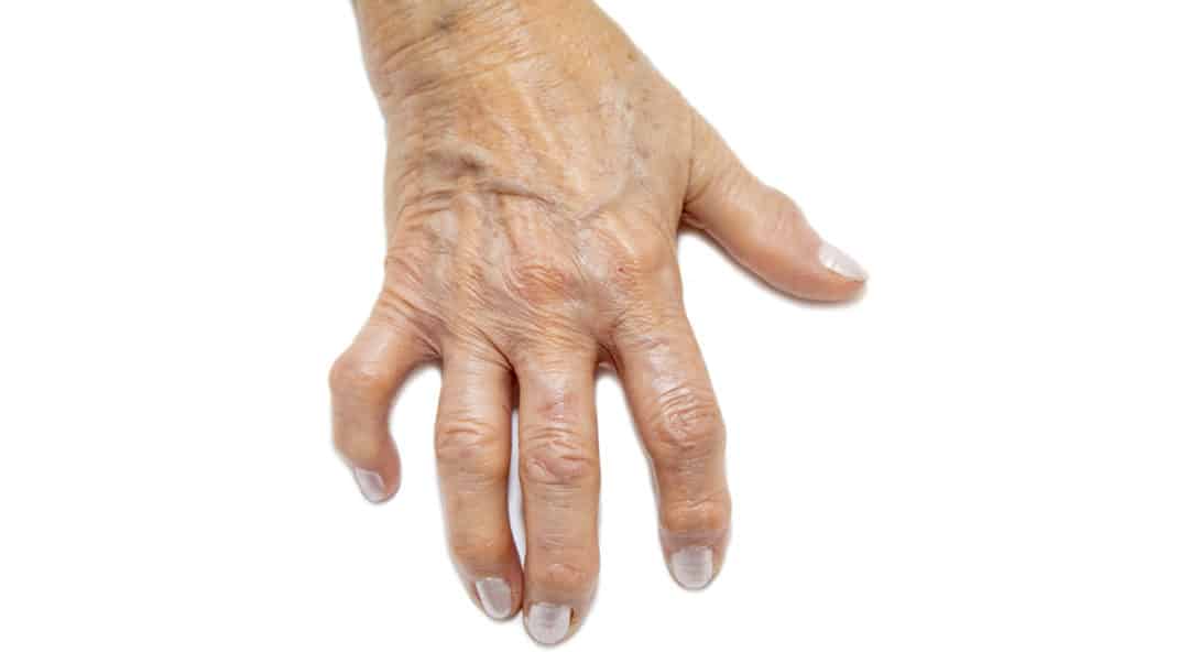 Arthritic hand to represent people with disabilities
