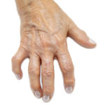 Arthritic hand to represent people with disabilities