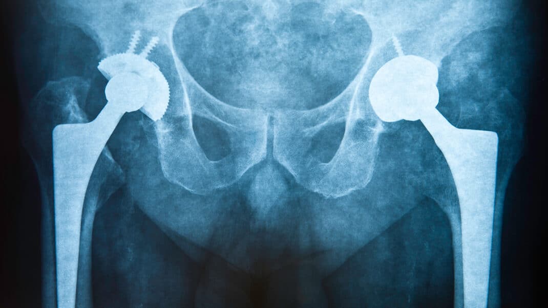 X-ray of bone fracture on plant-based diet