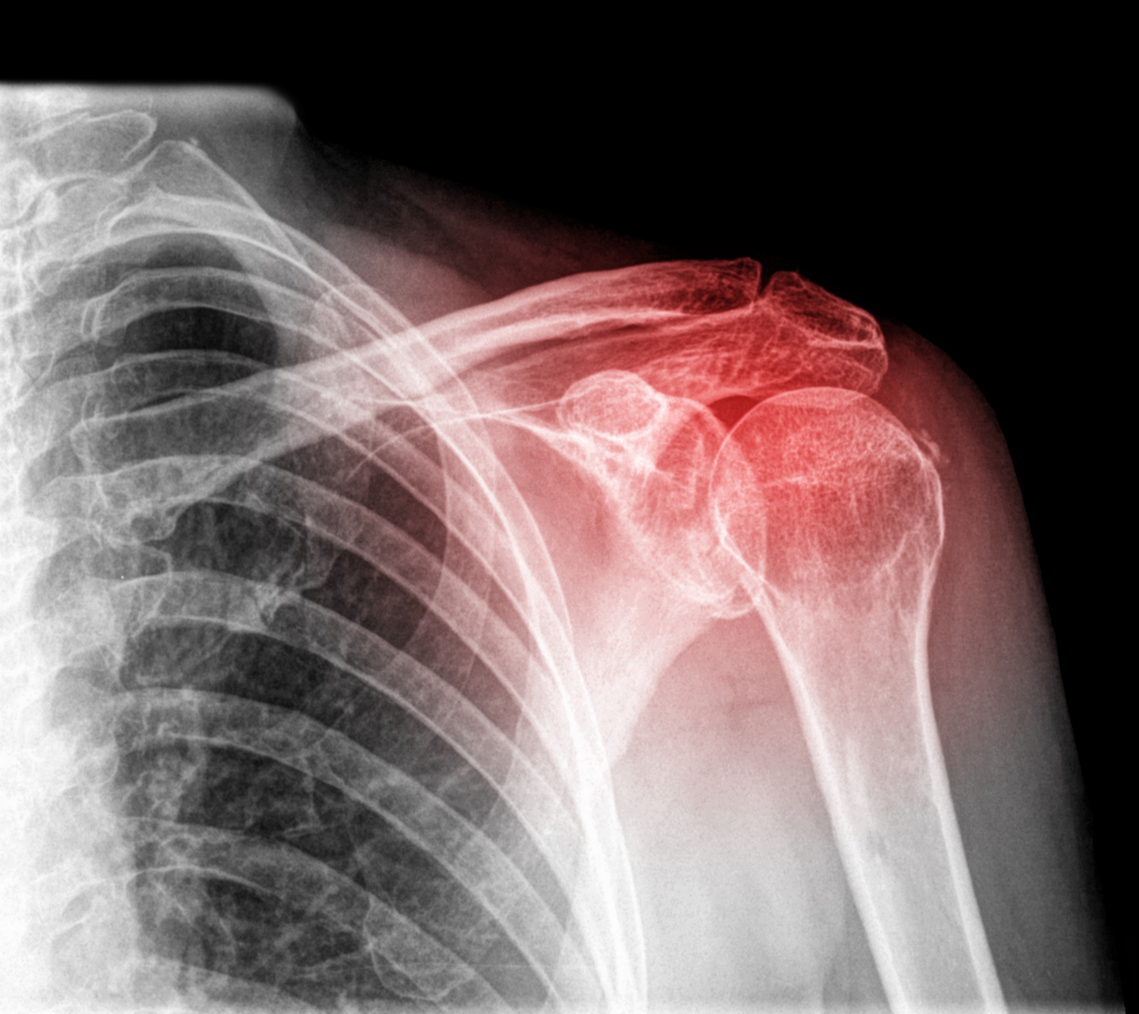Показать разрыв. Вывих левого плечевого сустава рентген. Плексит плечевого сустава рентген. Посттравматический омартроз плечевого сустава. Остеоартроз плечевого сустава рентгенограмма.